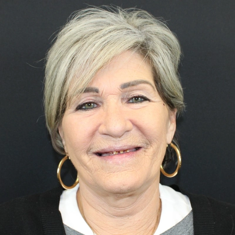 Pamela before treatment
